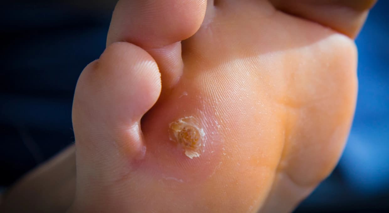 Helomas + Pedicura Clínica