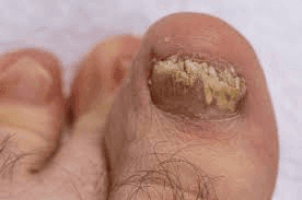Onicomicosis (Hongos)