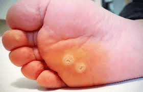 Verrugas Plantares + Pedicura